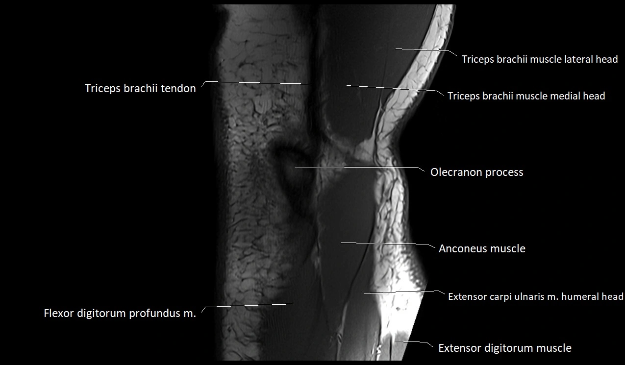 Elbow coronal anatomy image  cross sectional 3T MRI image 30.webp